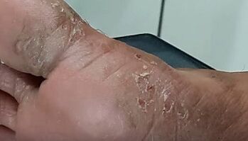 tipi e forme di funghi sulle dita dei piedi
