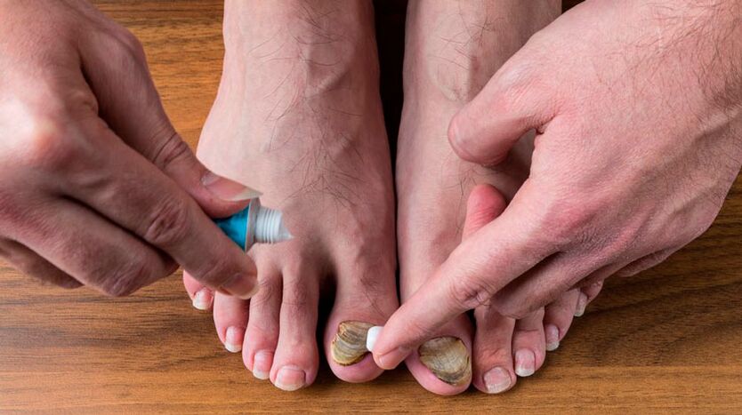 Applicazione di crema antifungina sulle unghie dei piedi per trattare l'onicomicosi